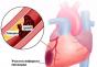 Инфаркт миокарда: симптомы у мужчин, первые признаки и последствия