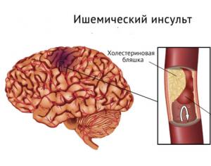 Ишемический инсульт головного мозга