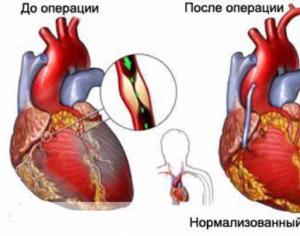 Способы лечения инфаркта миокарда